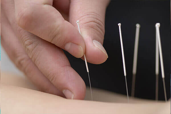 Acupuncture in Saddle Brook